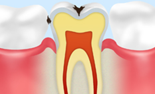 中期のむし歯 