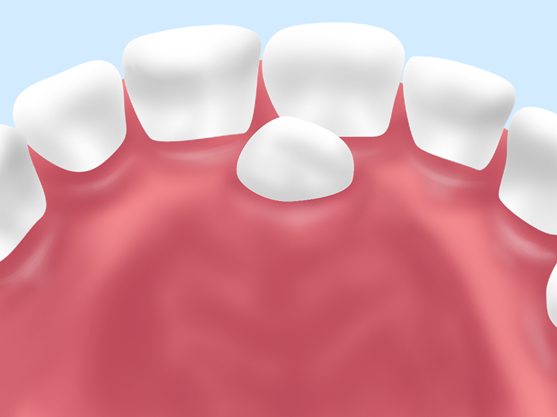 多数歯・過剰歯
